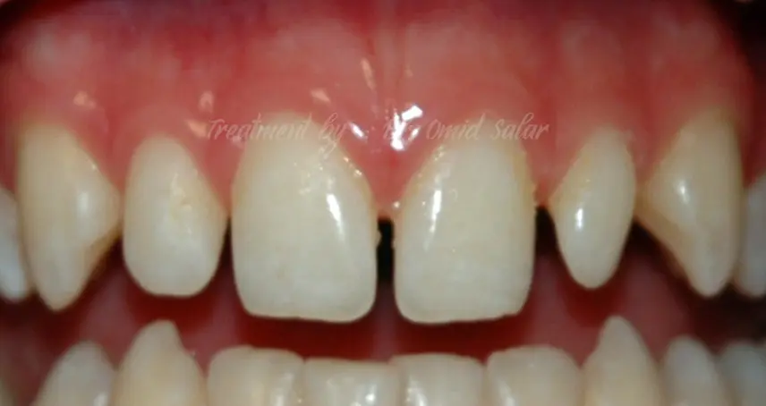 gaps between teeth 