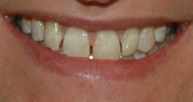 4 Methods To Close Gaps Between Teeth Trusted Dental Gold Coast