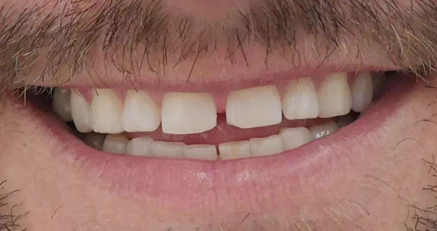 Gaps between teeth and grinding