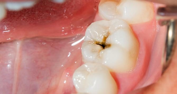 Tooth Worms and Other Cavity Causes