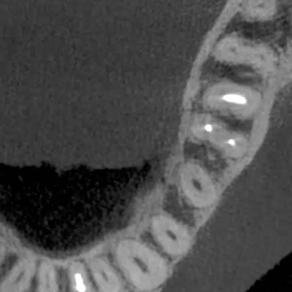 CBCT Scan of teeth