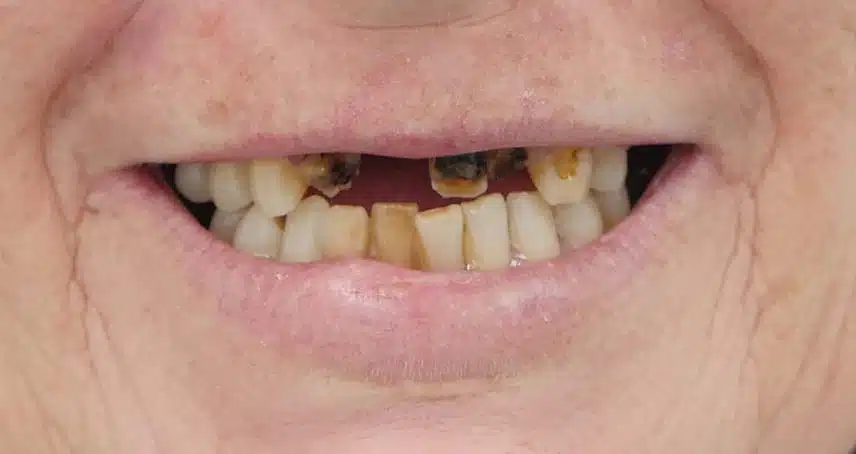 front missing and broken teeth