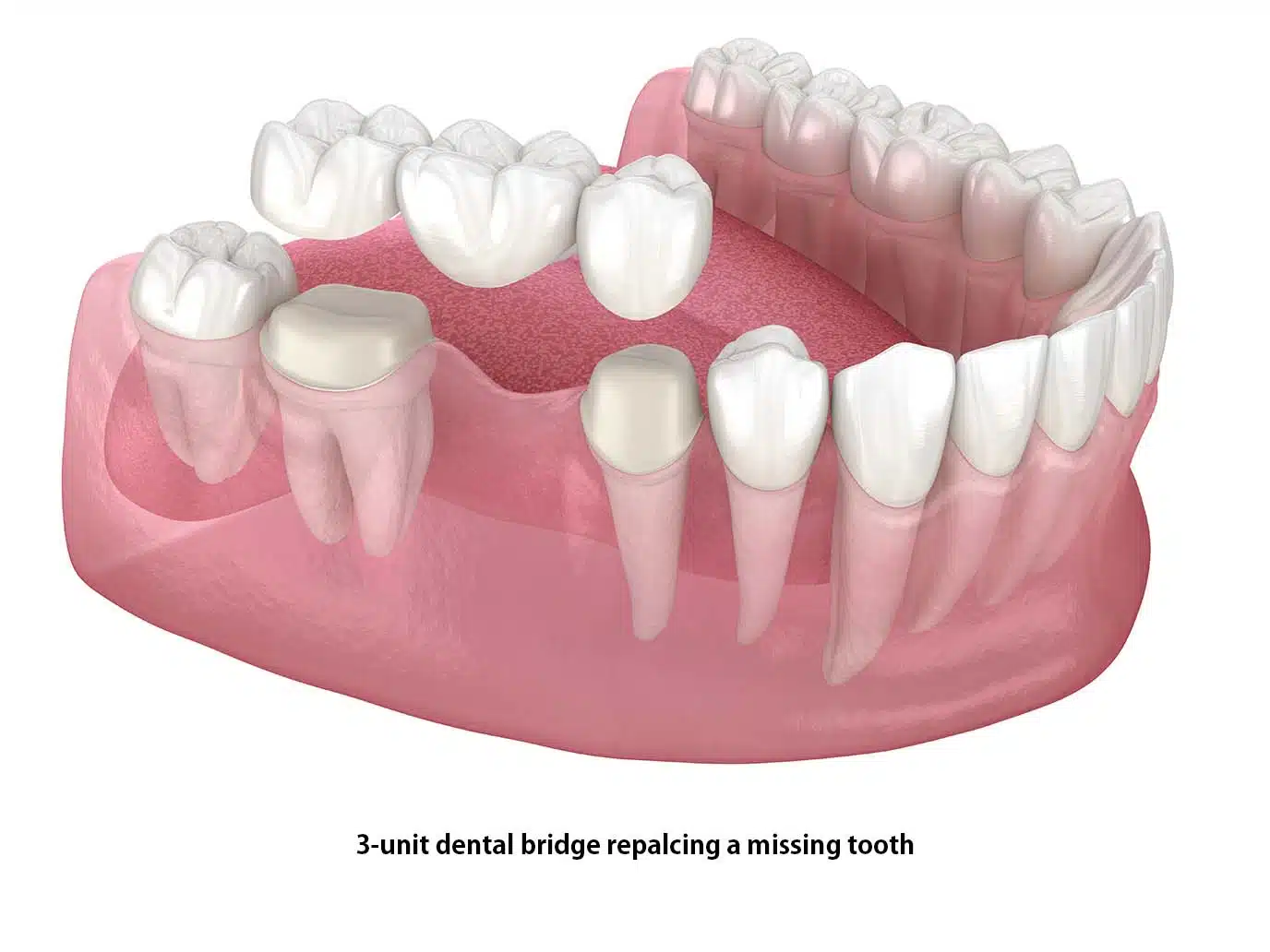 Dental Bridge replacing a missing tooth