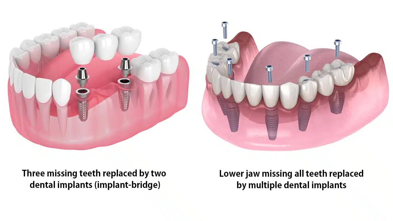 Multiple missing teeth replaced by dental implants